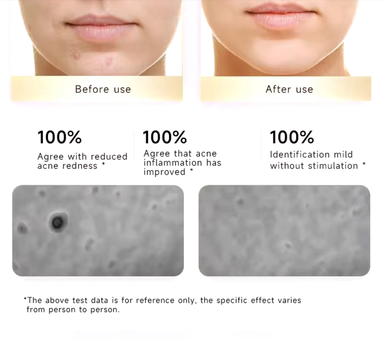 INNOVATIVE Small Button Electronic Acne Hydrocolloid Patch- 4 pieces